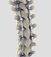 Complex Spinal Reconstruction