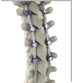 Complex Spine Surgery