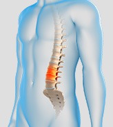 Degenerative Disc Disease