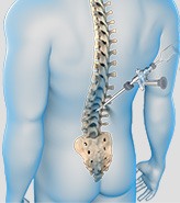 Endoscopic Spine Surgery