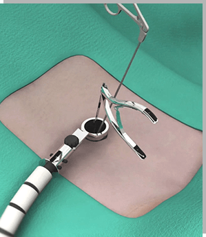 Minimally Invasive Spinal Surgery