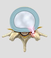 Herniated Discs