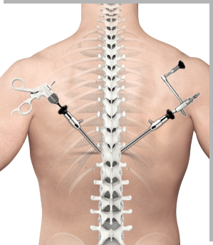 Endoscopic Spine Surgery