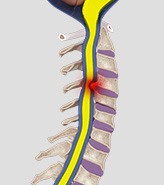 Myelopathy