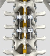 Spinal Fusion