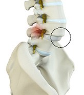 Spondylolisthesis