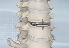 Artificial Cervical Disc Replacement