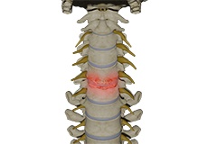 Cervical Degenerative Disc Disease