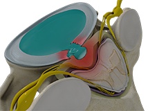 Cervical Disc Herniation