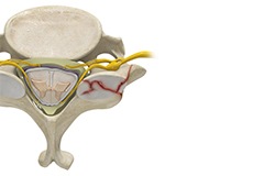 Cervical Fracture