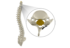 Cervical Laminoplasty