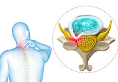 Cervical Radiculopathy/Myelopathy