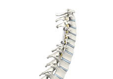 Cervical Spine Fusion