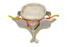 Cervical Stenosis