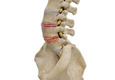 Degenerative Disc Disease