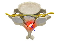 Epidural Abscess