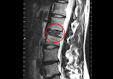 Pathological Fractures of the Spine