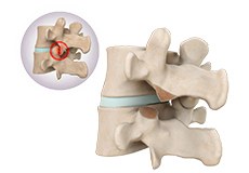 Removal of Facet Joint Cyst