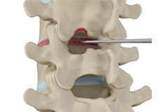 Spinal Decompression