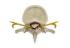 Spinal Stenosis