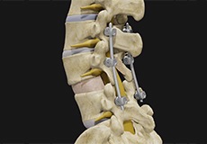 Spondylolisthesis Reduction & Fusion