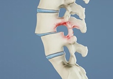 Spondylolisthesis