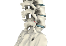 Spondylolysis