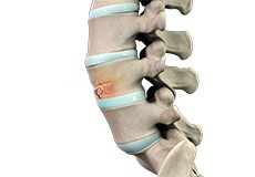 Vertebral Compression Fractures